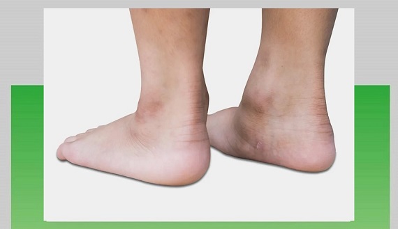 کفی طبی برای کف پای صاف کودکان