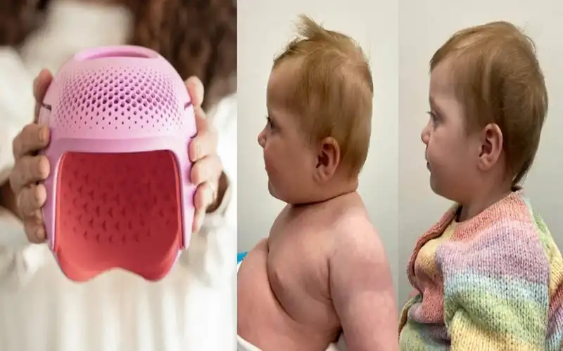 گرد شدن سر نوزاد