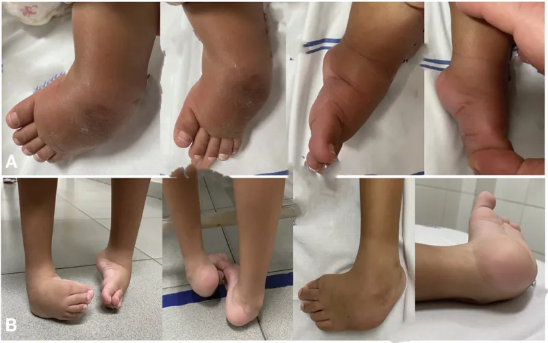 کلاب فوت (پاچنبری) 