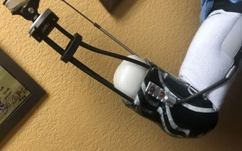 قیمت پروتز بالای آرنج