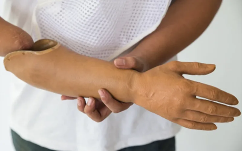 اختلاف قیمت پروتز زیر آرنج 