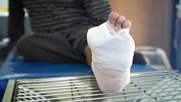 کنترل قند خون برای پیشگیری از قطع عضو
