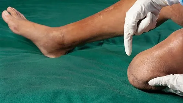 زخم پای دیابتی در مراحل اولیه
