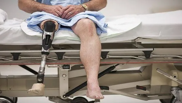 پروتز بعد از قطع عضو دیابتی