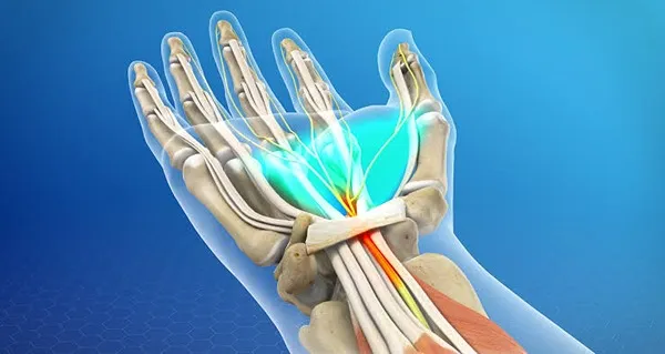 علائم سندرم تونل کارپال