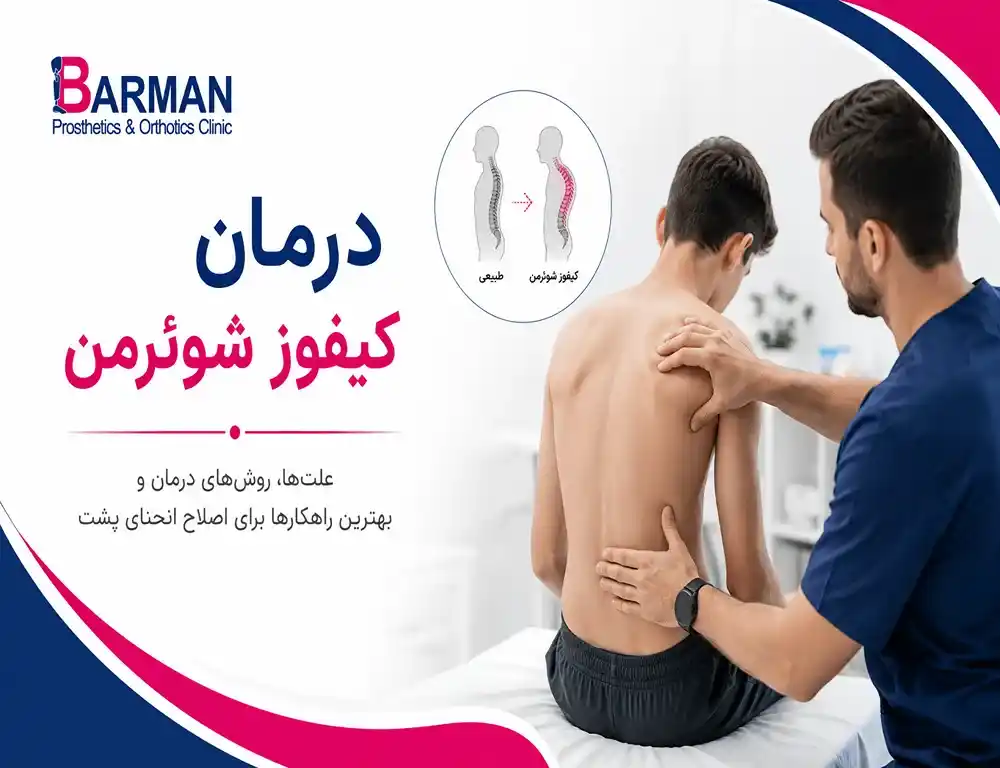 درمان کیفوز شوئرمن