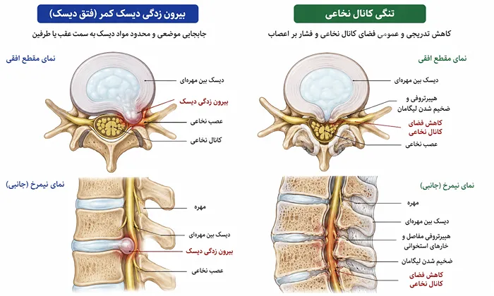 تفاوت دیسک کمر و تنگی کانال نخاعی