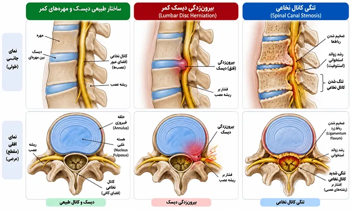 تفاوت علائم دیسک کمر و تنگی کانال نخاعی